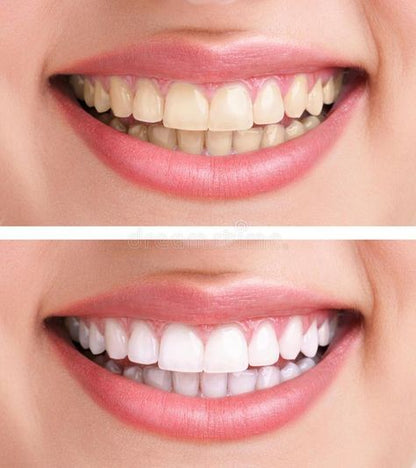 Dazzling White blanqueamiento dental